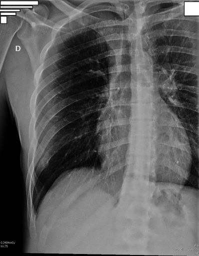 Rib Cage Radiograph